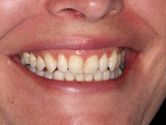 Before Damaged Front Teeth Wellington Road Dental Care