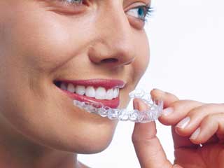 Invisalign Aligner