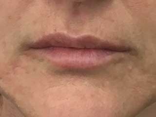 after lip lines