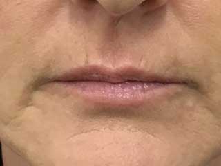 before - pesky lip lines