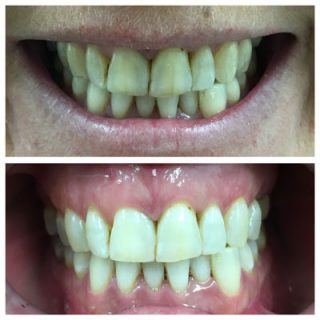 In chair teeth whitening with bleach