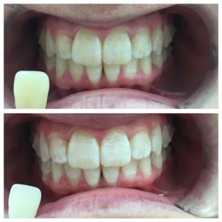 In chair teeth whitening with bleach