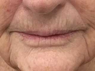 mature lips before