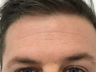 wrinkle-relaxers-before